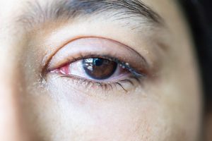 watery eyes