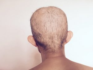 permanent hair loss from Taxotere