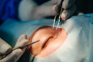 eye surgery to correct canalicular stenosis
